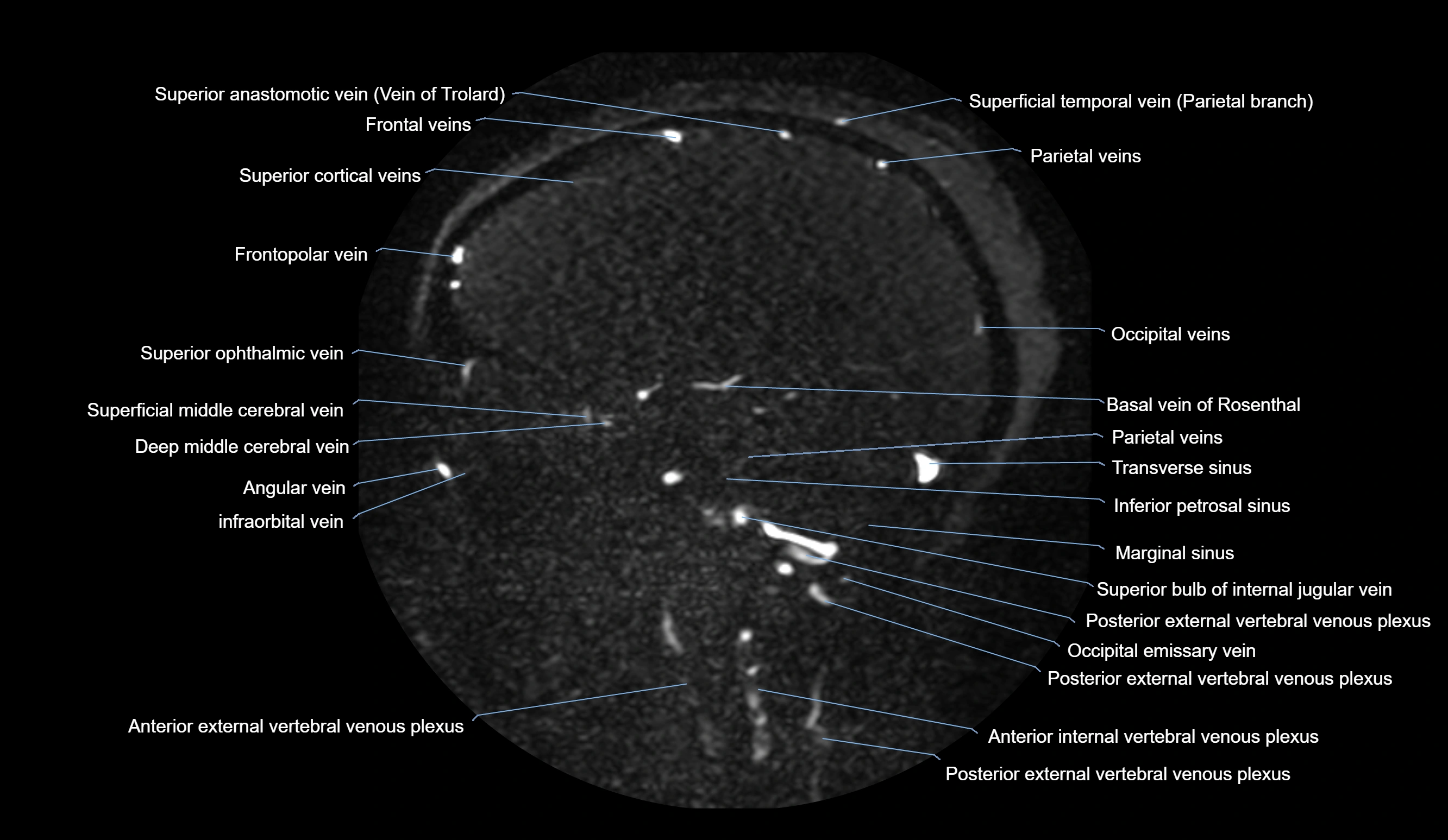 MRV brain sagittal anatomy 3T MRI images -img-01015-00033.webp